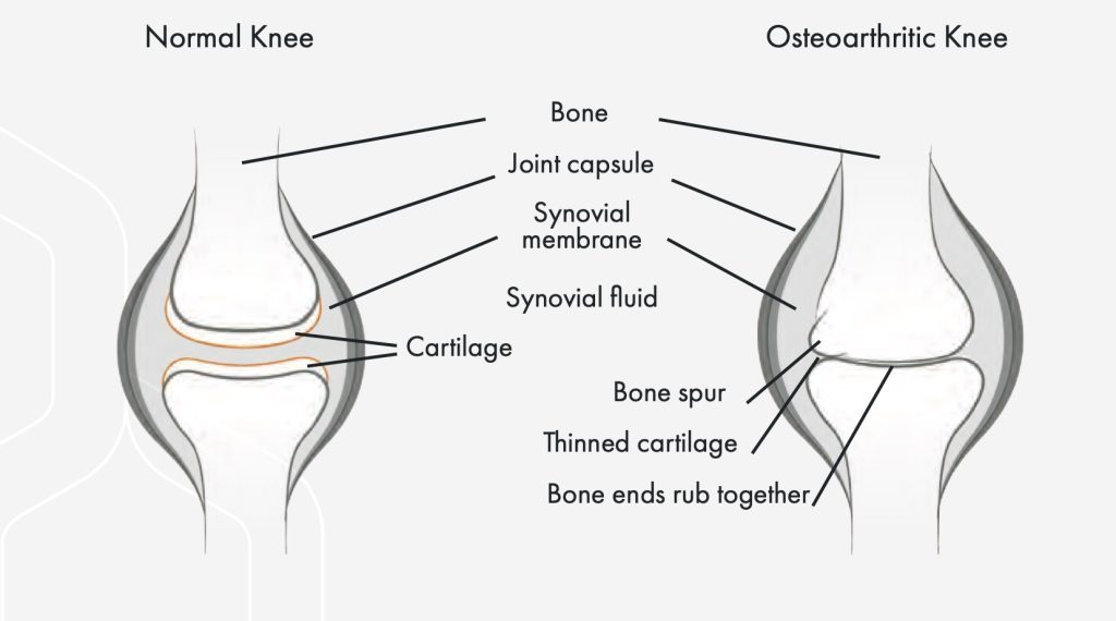 Arthrosamid