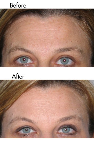 Successful treatment of forehead lines at our Botox clinic Manchester.