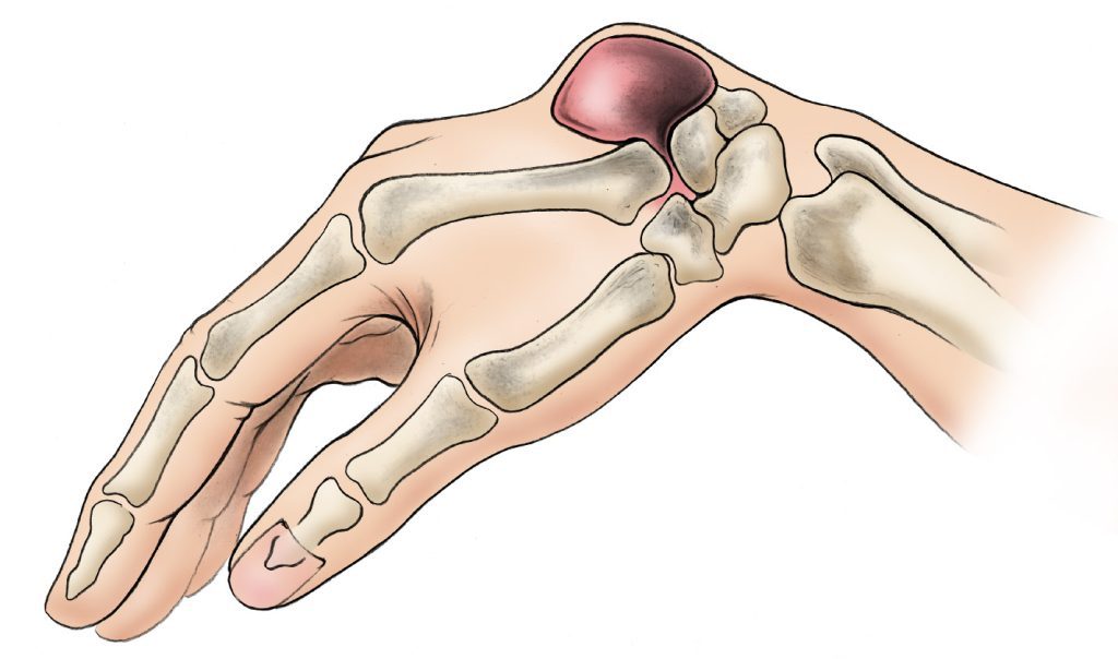 Ganglion cyst removal at Canova Medical Liverpool