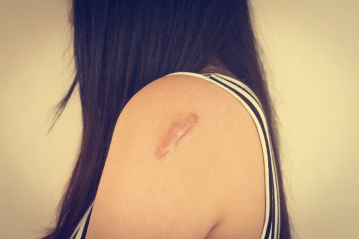 Keloid removal and scar treatment at Canova Medical Liverpool