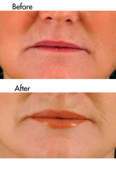 Lips enhanced with dermal filler