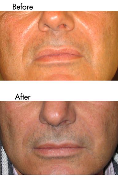 Male deep nose-to-mouth lines treated with dermal fillers