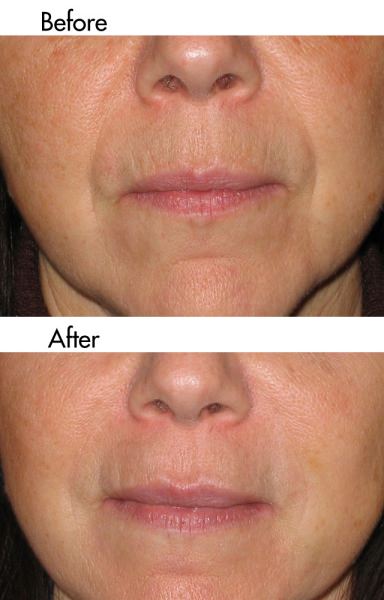 Before and After Pictures of non-surgical face lift treatments in our Manchester clinic.