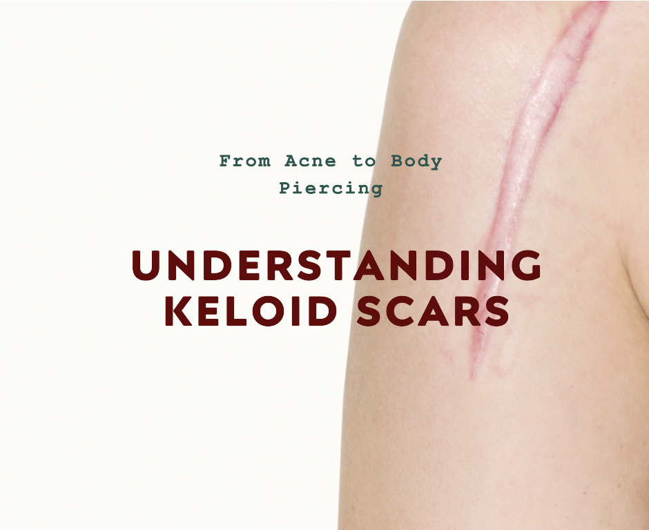 Understanding Keloid Scars From Acne to Body Piercing