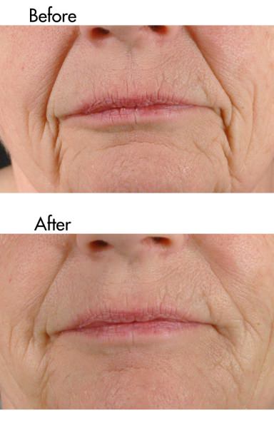 Before and After Pictures of a patient with very deep lines, treated with dermal fillers.