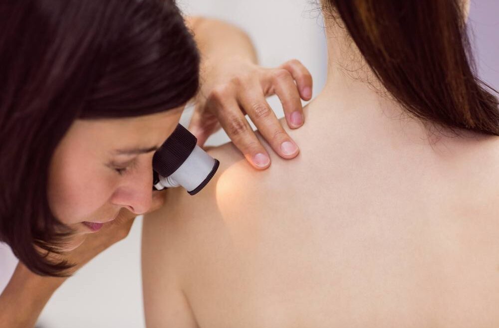 Wart and verruca treatment at Canova Medical London