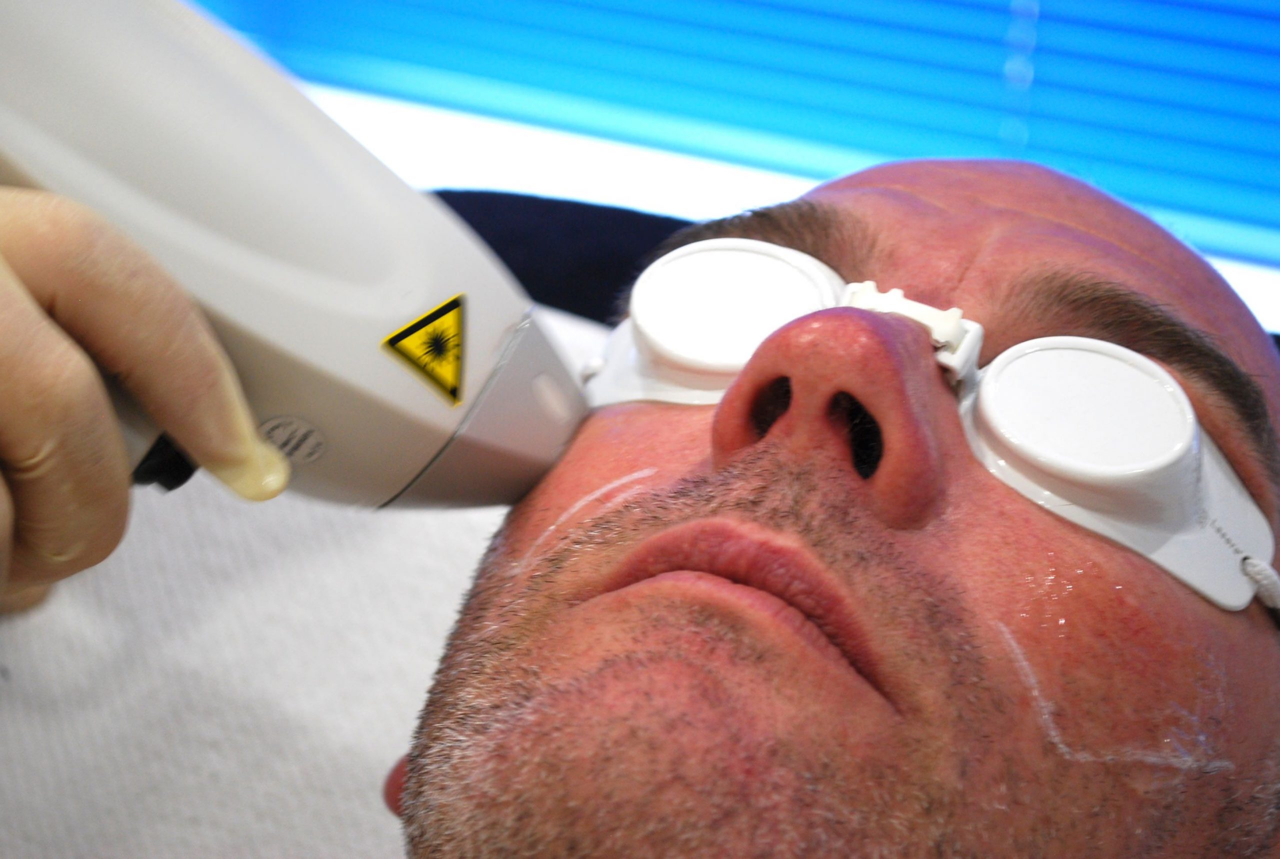 Men face laser hair removal treatment