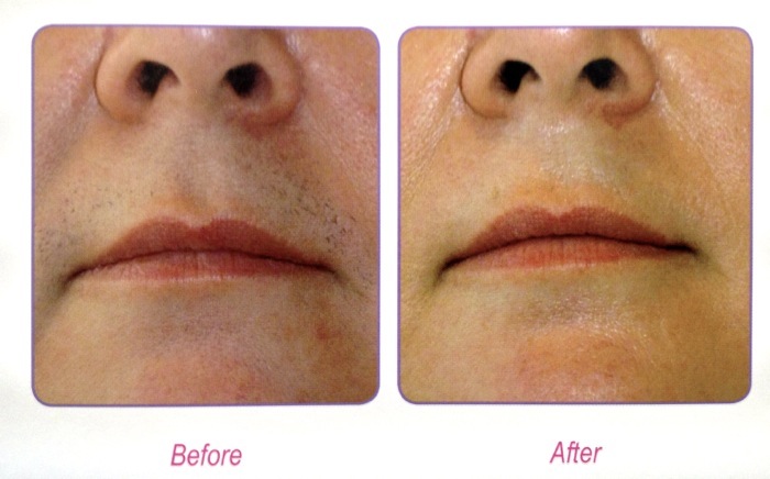 Lips Treatment: Before and after 6 session of laser hair removal